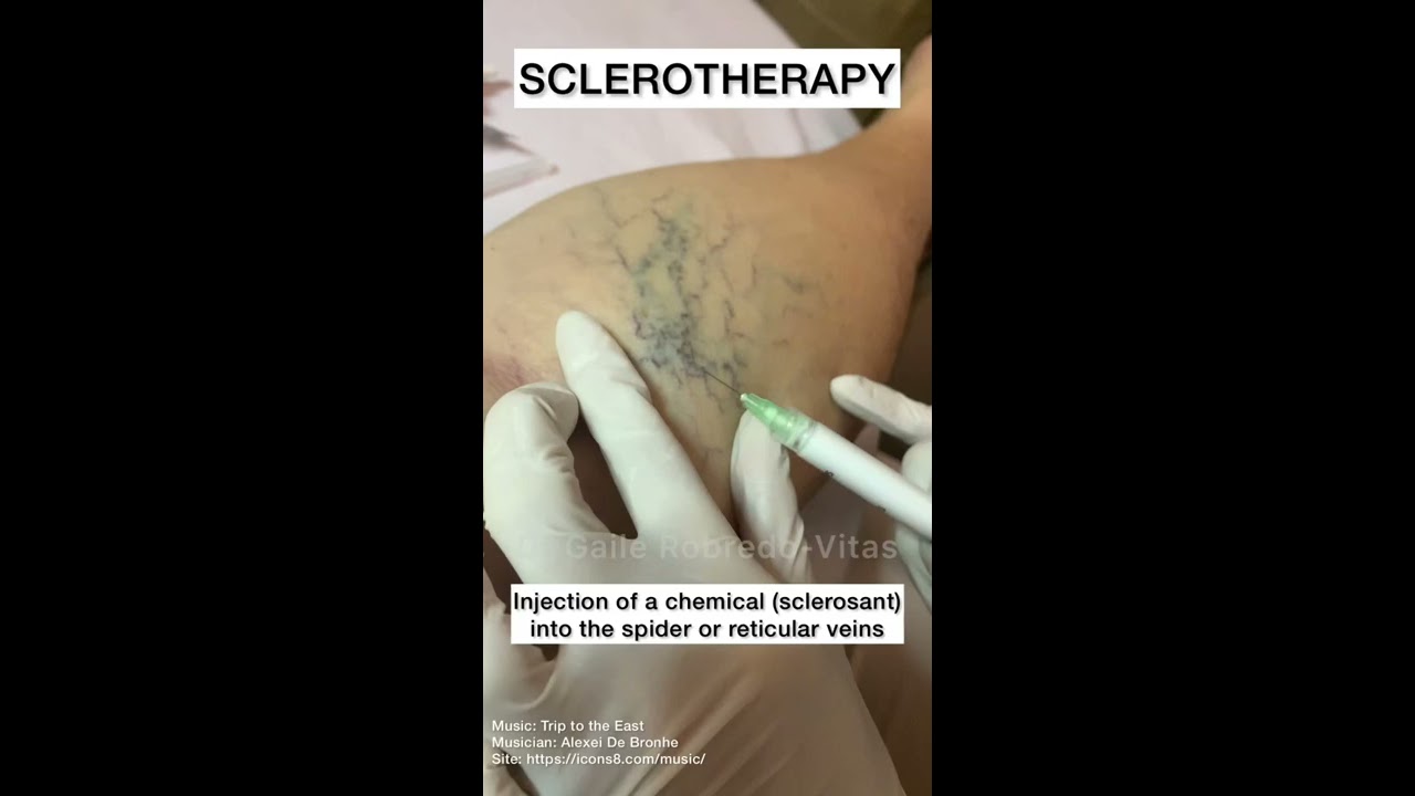 Sclerotherapy For Spider And Varicose Veins Shorts