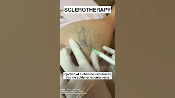 Sclerotherapy For Spider And Varicose Veins Shorts 