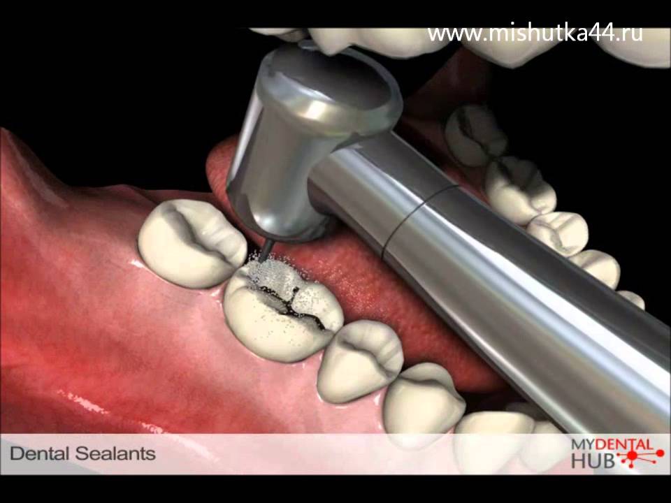 Высокоскоростной пневматический стоматологический наконечник стоматологическое о