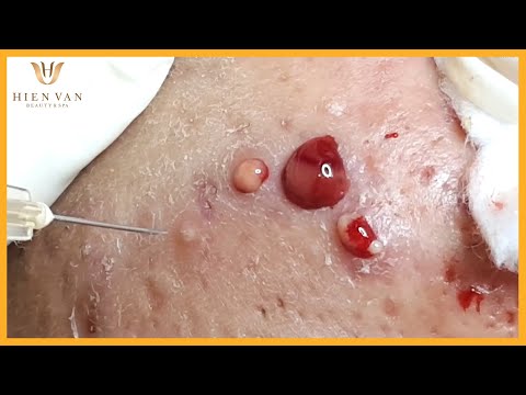 Video Inflammatory Acne I Điều trị mụn viêm nang hiệu quả số... - youtube