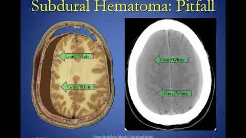 Intracranial Hemorrhage Version 2 0
