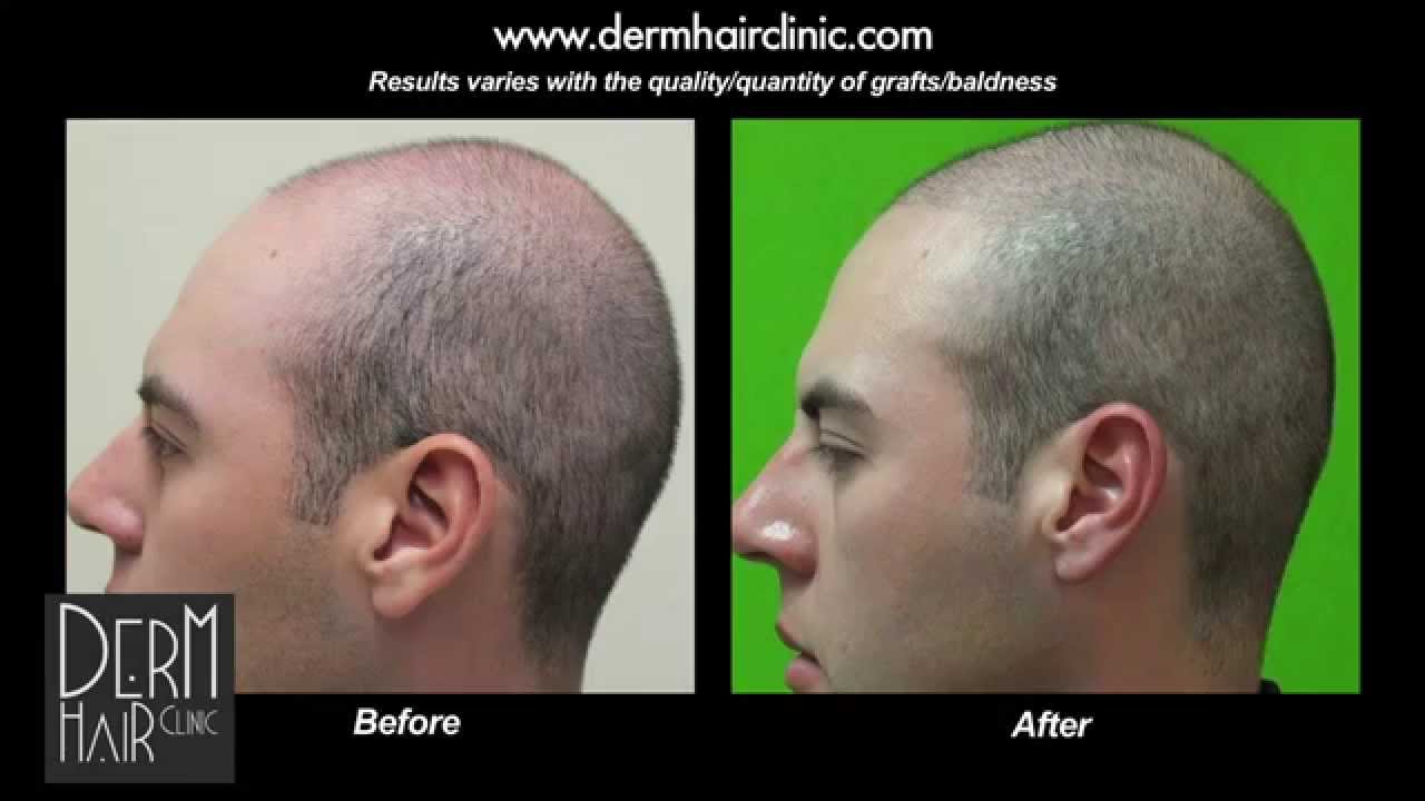 Los Angeles FUE Hair transplant  Buzz cut after body hair transplant and  strip scar repair  YouTube