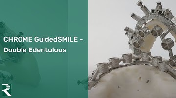 CHROME GuidedSMILE - Double Edentulous Surgery