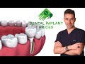 أسعار زراعة الأسنان 2020 اسطنبول تركيا | Dental implant prices turkey