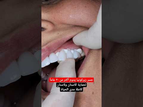 جسر وتلبيسات اسنان زيركون لأسنان كاملة
