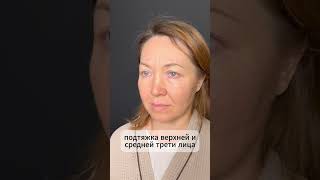 Подтяжка верхней и средней трети лица
