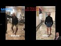 Bilateral TKR - total knee replacement in varus knee