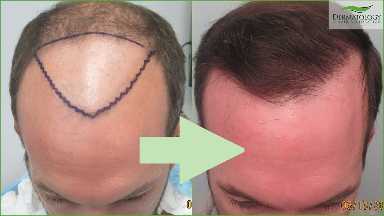 FUE Hair Transplant UPDATE Los Angeles Before and After YouTube