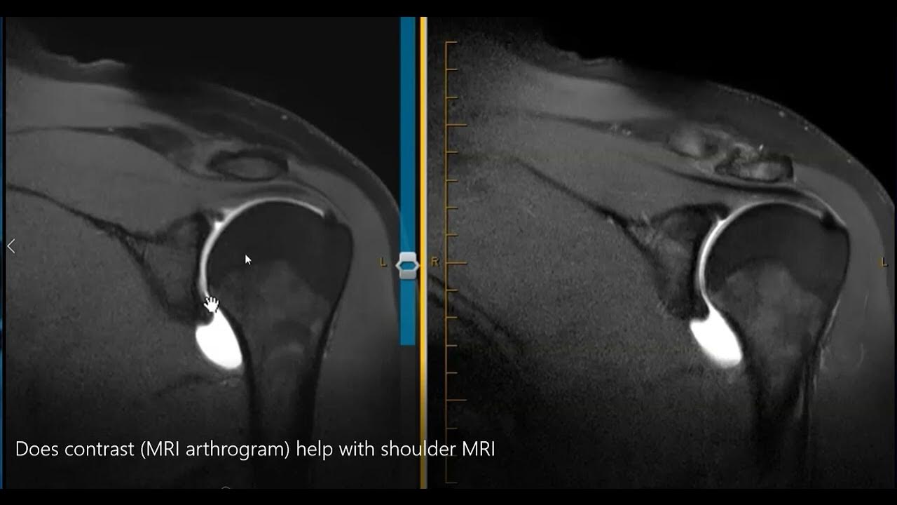 Does mri arthrogram help see the labrum youtube