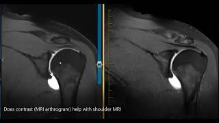 Does MRI arthrogram help see the labrum?