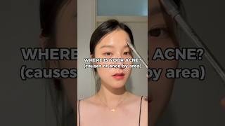 CAUSES OF ACNE BY AREA: Where is your acne?👇 #skincaretips #acnetreatment #koreanskincare