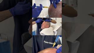 PRP 🔗 Hair Transplant