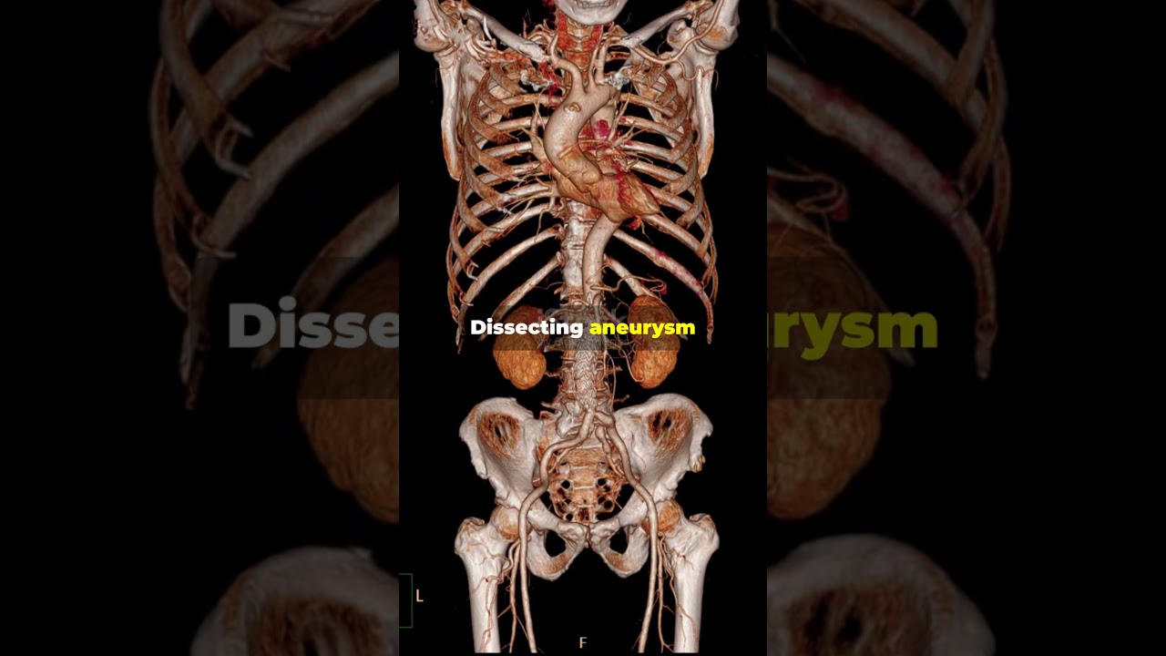 Aneurysms Explained 🧠🫀 | Types, Causes & Risks | Med Clarified 