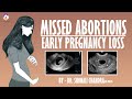 Missed Abortion : Early Pregnancy Loss : Clinical Scenarios : Dr. Shonali Chandra