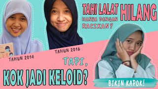 GAGAL MENGHILANGKAN TAHI LALAT BERUJUNG KELOID