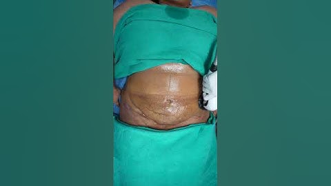 360° Abdomen Liposuction result | RF Session #shorts