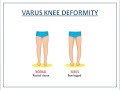 SEVERE VARUS DEFORMITY IN OA KNEES