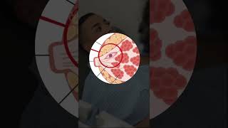 Respondiendo dudas: condiloma vs papiloma #shorts