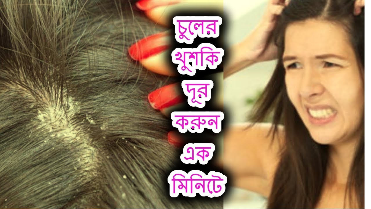 How to remove hair dandruff[Bangla tips] YouTube