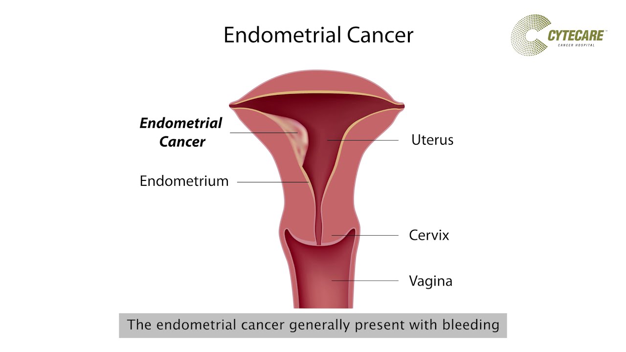 endometrial cancer detection