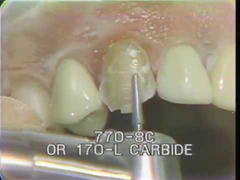 Maxillary Cuspid Preparation for a Porcelain Fused to Gold Crown