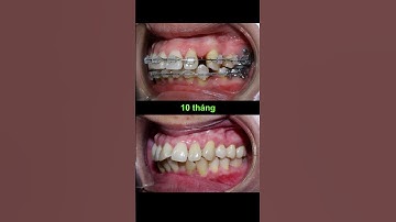 Niềng răng hô trong 24 tháng