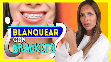 ¿Cómo mantienes tus dientes blancos con brackets?