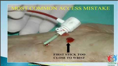Difficult Radial Anatomy in Coplex PCI