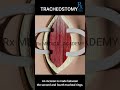 🔹 Tracheostomy in 60 Seconds 🔹Life-saving airway access – simplified, visualized, and demystified.