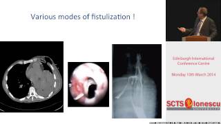 Surgical Treatment of Complex Thoracic Infections