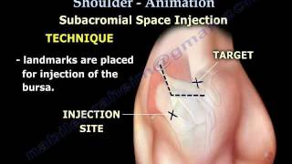 Shoulder bursitis, Tendonitis Injection Animation  Everything You Need To Know  Dr. Nabil Ebraheim