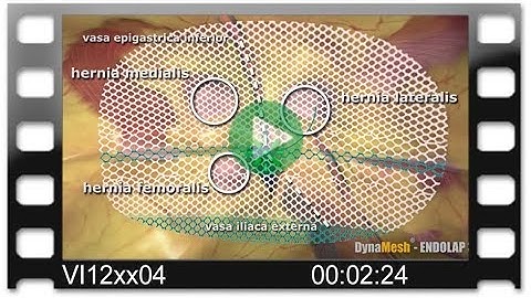 DynaMesh®-ENDOLAP 3D - Animation: Total Extraperitoneal Endoscopic Hernioplasty (TEP)