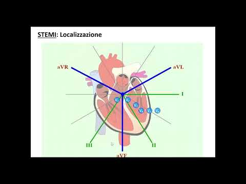 Video: Quale variazione dell'ecg è tipica dell'ischemia cardiaca?