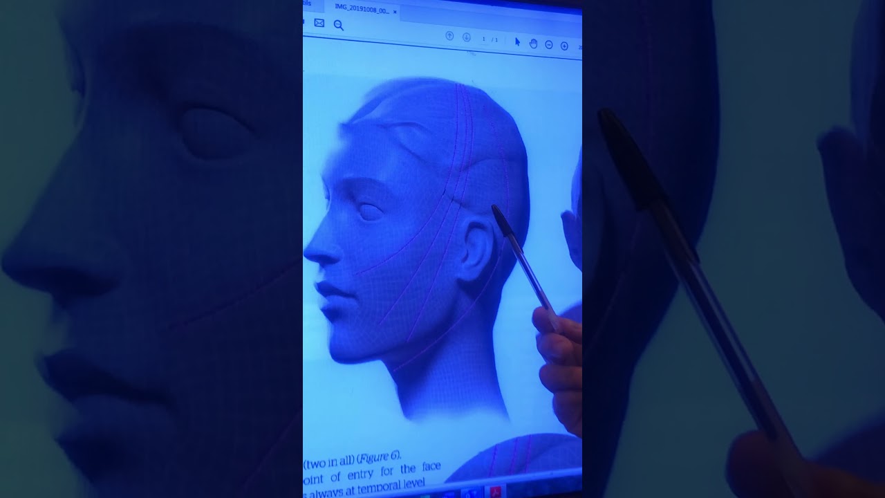 INTERET OU PAS DE LA POSE DES FILS TENSEURS DANS LE VISAGE ?