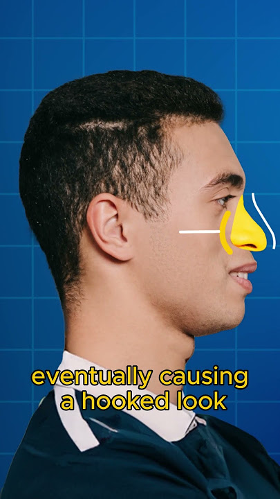 How Do I Know If I Have A Recessed Maxilla?🤔