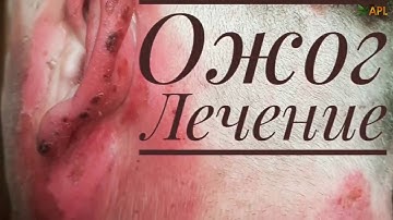 Ожог лечение леденцами APL. APLGO отзывы. Клеточное питание APL