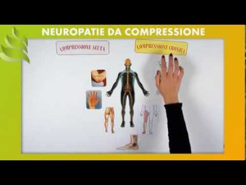 Neuropatie da Compressione