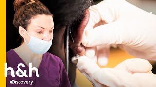 Esta Youtuber Sufre Por Los Queloides En Su Oreja Clínica De La Piel Discovery H&H