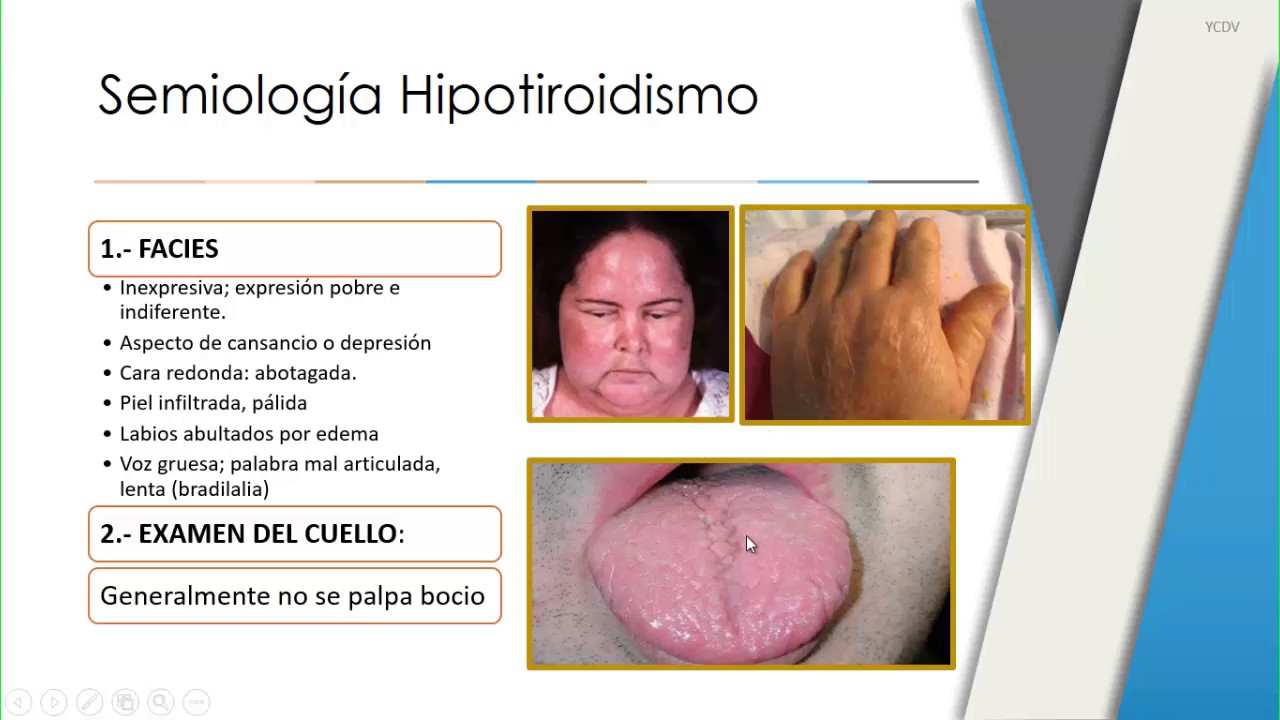 Hipotiroidismo cara hinchada