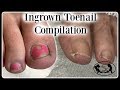 👣Satisfying Ingrown Toenail Pedicure Compilation👣