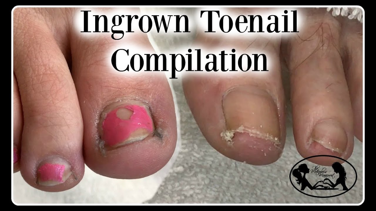 👣Satisfying Ingrown Toenail Pedicure Compilation👣 YouTube