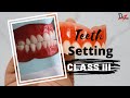 PROSTHODONTICS | Class Three Teeth Arrangement Made Easy