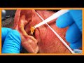 Eds earwax extravaganza  auburn medical group