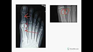 Sesamoid bones