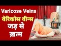 Self cure for vericose veins  full yoga  diet for vericose veins       