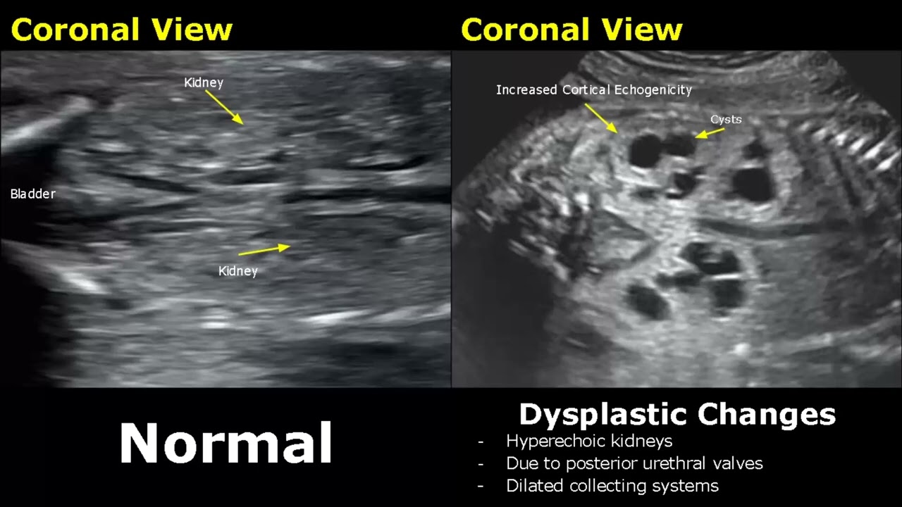 Fetal Kidneys Ultrasound Normal VS Abnormal Image Appearances Kidney 