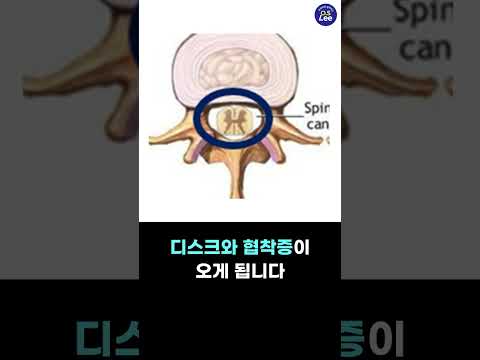 허리 디스크와 척추관 협착증은 뭐가 다른가요? - 무엇이든 알려주는 O.S LEE #shorts
