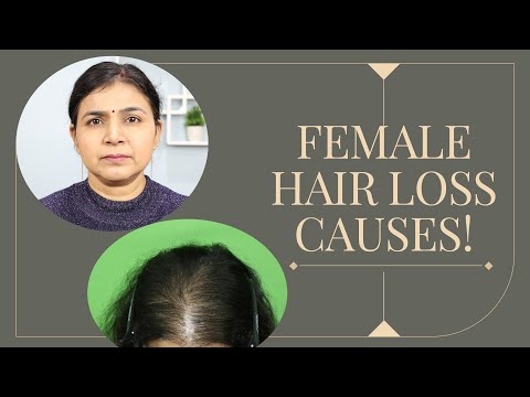 Female Pattern Baldness — What is the Best Treatment for It?