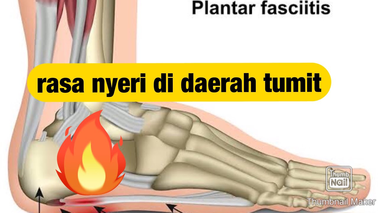 nyeri telapak kaki bagian belakang. mengobati nyeri telapak kaki