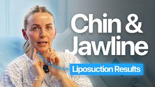 Chin & Jawline Liposuction Results
